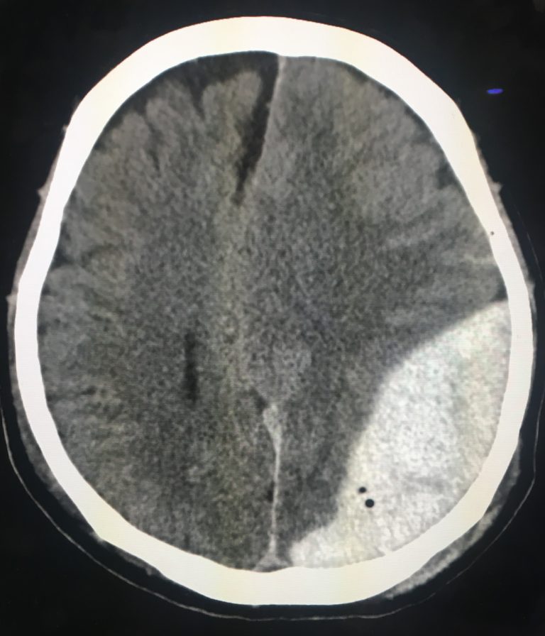 急性硬膜外血腫について 医学をもっとわかりやすく